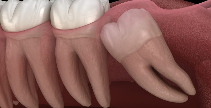 Do I Need Teeth Straightening After Wisdom Tooth Removal?