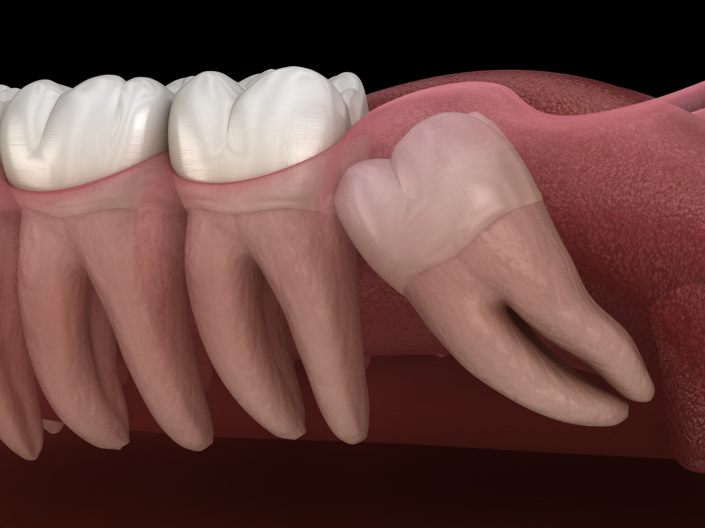 Do Need Teeth Straightening After Wisdom Tooth Removal