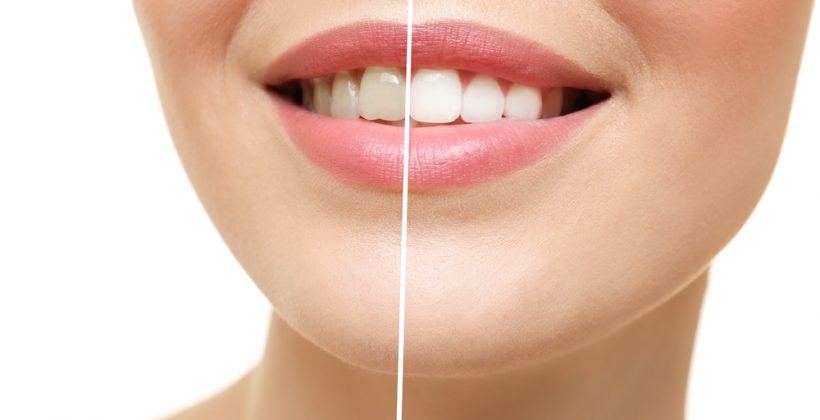 5 Ways Dentists Can Change Your Smile