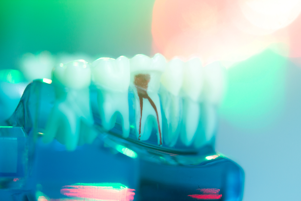 Ultimate Guide To Root Canals