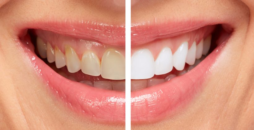 How Cosmetic Dentistry Can Give You The Confidence Boost You Need